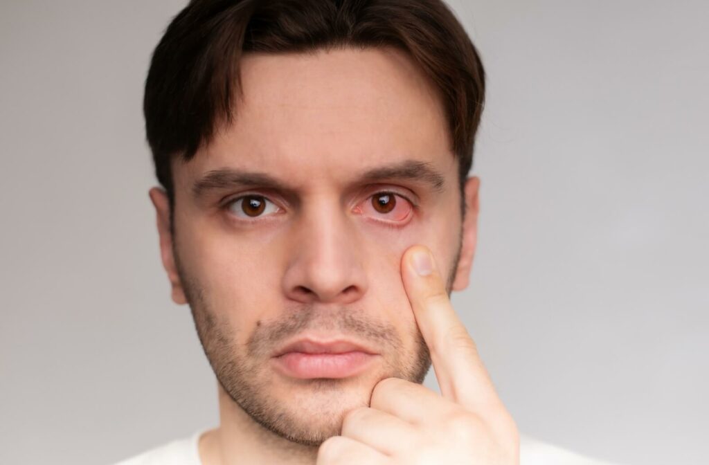 A man pulls his lower eyelid with one finger, exposing his red, dry irritated eye